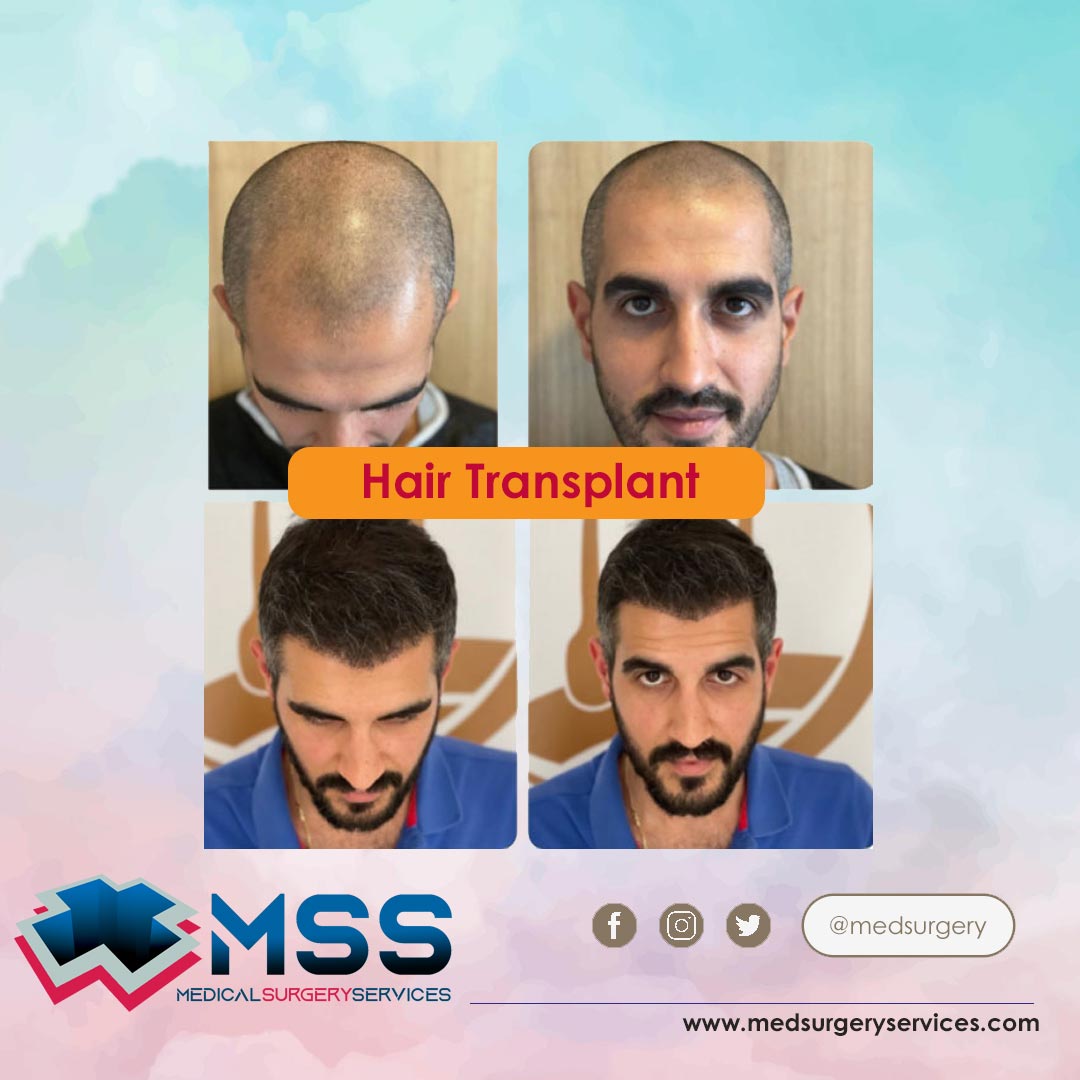 Hair Transplant - MedSurgeryServices